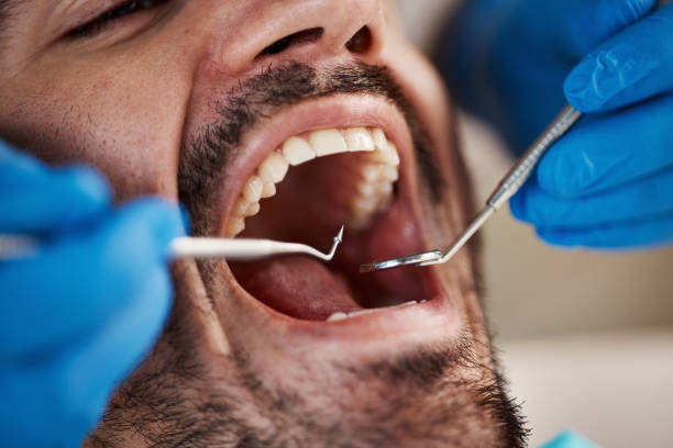Best Emergency Treatment for Dental Infections or Abscesses in Ephrata, PA